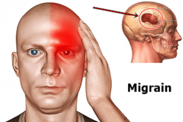 Ảnh 3 của Đau nửa đầu Migraine phức tạp (Có sự thay đổi về thần kinh)